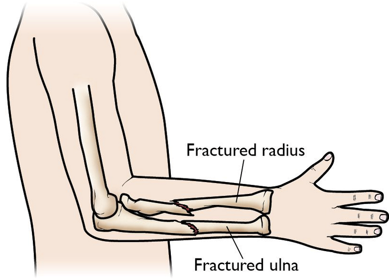 Fractured Forearm