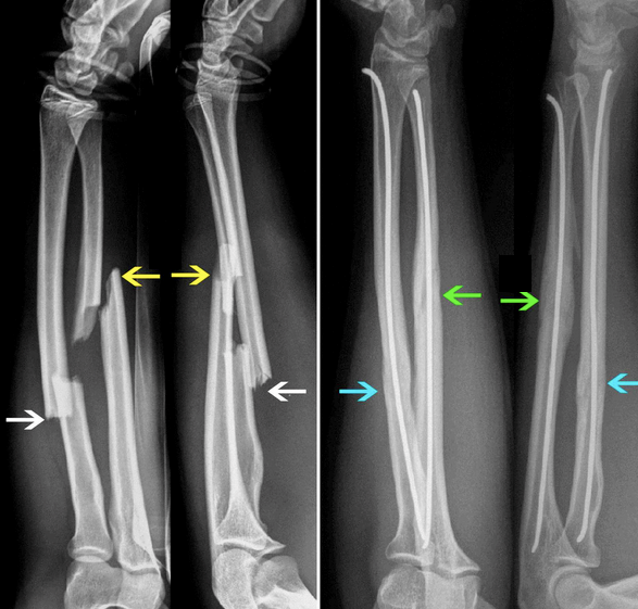 A BBFF reduced with TENS nails