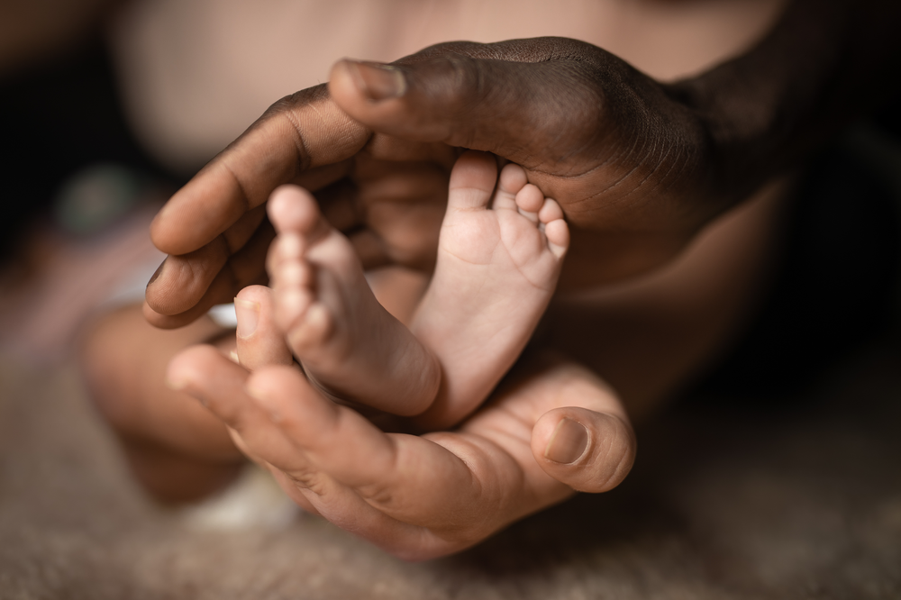 Fixed Clubfoot